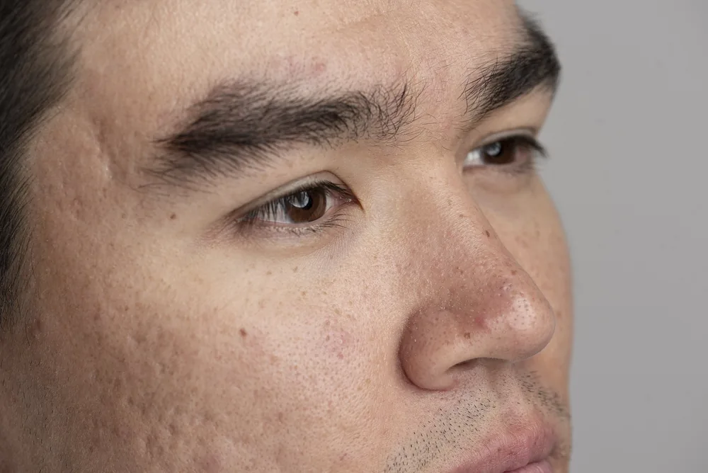 medical dermatology woman close-up-face with acne scars