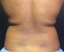 coolsculpting back before