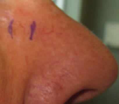 skin cancer on nose before MOHS surgery treatment