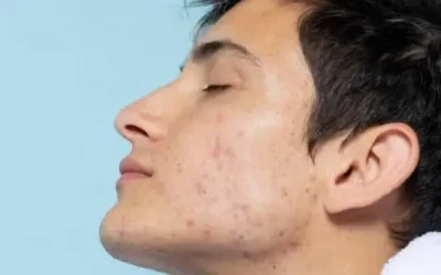 The Top 12 Acne Myths And Why They Aren’t True