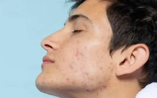 man-with-acne